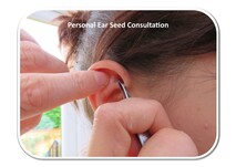 Picture of CalmPoint ear seeds being place on ear with tweezers