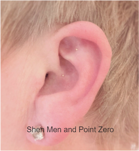 Female Ear with CalmPoint Ear Seeds on Shen Men and Point Zero Acupuncture PointsPicture