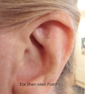Ear with CalmPoint Ear Seed on Shen Men Acupuncture Point